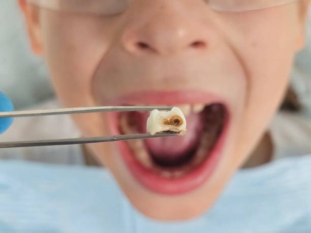 Best Emergency Dental Filling Replacement  in Ivanhoe, CA